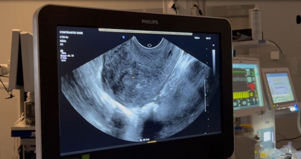 <strong>Traiter les fibromes utérins par radiofréquence, c’est possible !</strong> 1